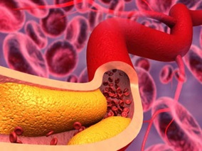 杂合子家族性高胆固醇血症：Lerodalcibep的长期有效性和安全性
