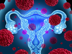 绝经后期颗粒细胞瘤致子宫内膜增厚1例