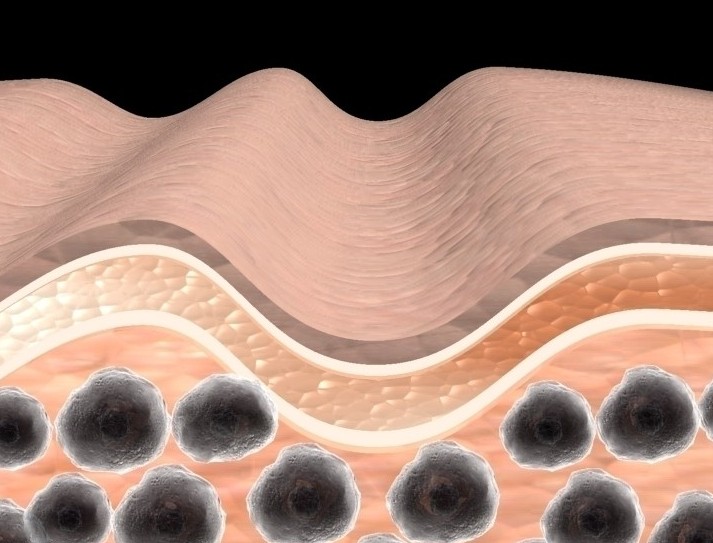 静脉注射免疫球蛋白可以有效控制JDM患者疾病活动度(Ann Rheum Dis. 2011 Dec;70(12):2089-94.)