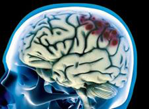 孕酮会改善外伤性脑损伤患者神经系统结局(Cochrane Database Syst Rev. 2012 Oct 17;10:CD008409.)