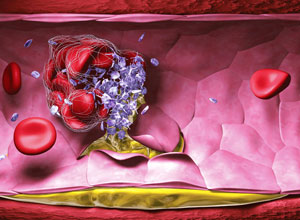 低剂量阿司匹林预防再发性静脉血栓栓塞（N Engl J Med 367(21): 1979-1987.）