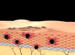 静脉注射免疫球蛋白可以治疗难治性皮肤结节性多动脉炎（Intern Med J. 2012 Apr;42(4):459-62. doi: 10.1111/j.1445-5994.2012.02739.x.）