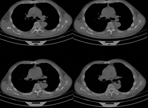 硼替佐米-沙利度胺-地塞米松用作新确诊多发性骨髓瘤患者自体干细胞移植后的巩固治疗的疗效优于沙利度胺-地塞米松（Blood. 2012 Jul 5;120(1):9-19）