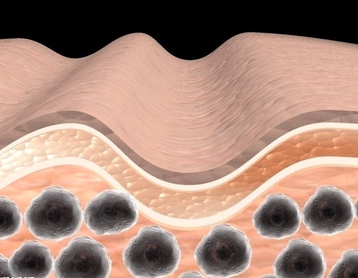 罗红霉素导致的中毒性表皮坏死松解症（Ther Drug Monit. 2012 Aug;34(4):359-62.）
