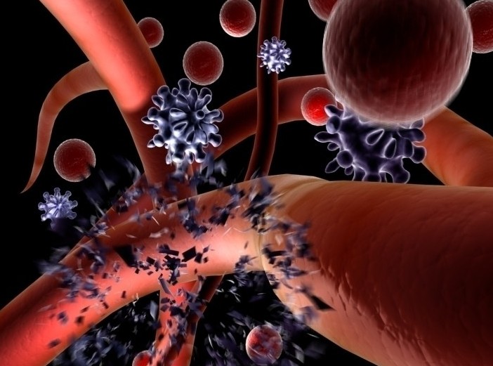 新诊断的急性髓系白血病老年患者的生存率：表观遗传治疗PK强化的化疗方案（Stroke. 2013 Jan;44(1):94-8.）