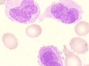 二联抗血小板治疗并不比单药能更多降低卒中复发风险