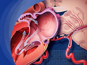 HFpEF患者：起始厄贝沙坦治疗后WRF与不良结局风险较高相关