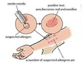 围手术期氯己定过敏诊断检查的特异性和敏感度
