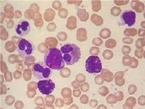 低或中度风险APL患者可首选ATRA+三氧化二砷作为一线治疗