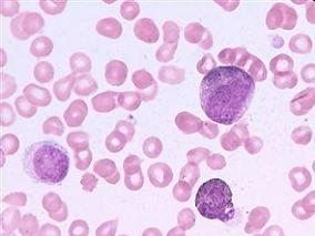 中等剂量环磷酰胺治疗SAA有明显毒性且不能阻止复发