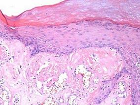 复发AL患者中单药硼替佐米可带来持久的血液学应答