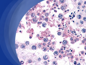 儿童急性淋巴细胞白血病治疗：甲氨蝶呤诱导的神经毒性是暂时性的