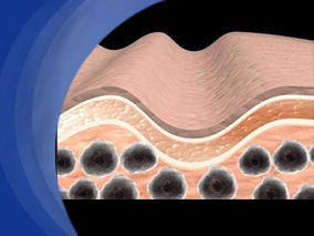 NSAID类药物导致的荨麻疹/血管性水肿在中期内不会发展成慢性荨麻疹