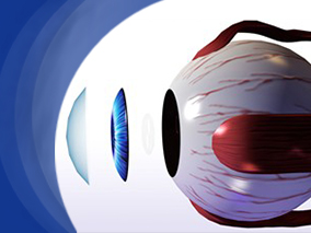 玻璃体黄斑粘连与全层黄斑穿孔治疗选择的成本效果和成本效用