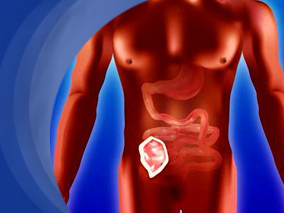 铁强化对肯尼亚婴儿肠道微生态产生不利影响