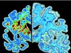 轻度至中度ADApoE4携带者:鼻内速效胰岛素给药的安全性及有效性分析