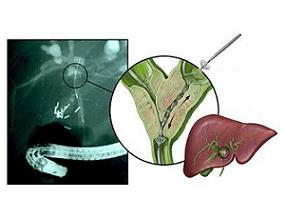 晚期胆道癌二线化疗的系统评价
