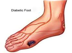 糖尿病足治疗的成本到底有多高？