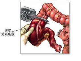 巯嘌呤使用超过12个月能降低71%结肠切除术的可能性