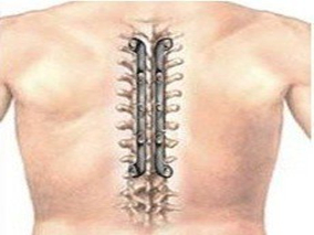 早期中轴型脊柱关节病：使用TNF抑制剂能否减少NSAIDs药物的使用量？