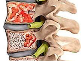 高风险骨髓瘤如何治疗？