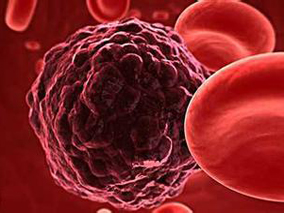 成年严重慢性原发性中性粒细胞减少症的特征和结局