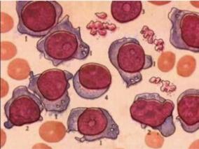 新诊断多发性骨髓瘤:聚乙二醇脂质体阿霉素和硼替佐米的疗效