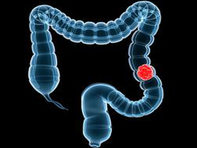 结直肠腺瘤切除后每日补充维生素D3和钙能减少复发风险吗？