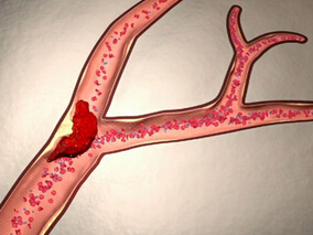 既往卒中发病3个月内静脉溶栓的安全性和功能结局