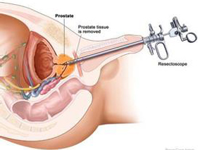 依维莫司联合吉非替尼治疗转移性去势抵抗性前列腺癌