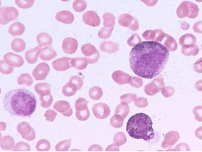 诱导化疗失败的AML患儿干细胞移植长期结局好