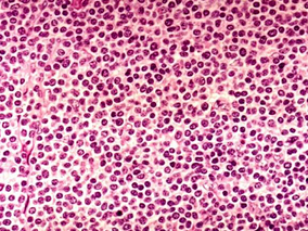 惰性NHL患者硼替佐米联合R-CHOP有效