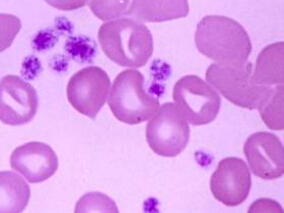 吗替麦考酚酯治疗重症免疫性血小板减少症的有效性