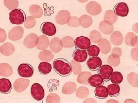 中性粒细胞减少患者进行粒细胞输注治疗是否有效？