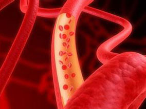 静脉栓塞患者停止抗凝治疗后服用舒洛地特能减少复发风险