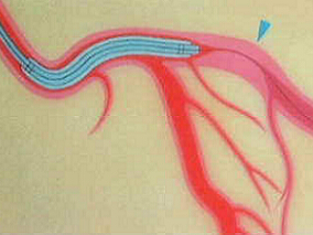 STEMI-PCI患者使用比伐卢定vs肝素联合糖蛋白IIb/IIIa抑制剂的抗凝比较