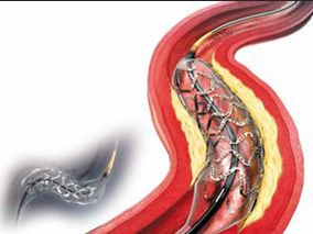 生物可吸收支架植入1年次要终点发生率与金属支架无差别