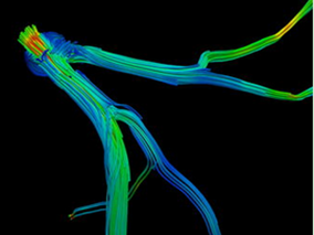 “双低”碘克沙醇扫描方案用于超重的CHD患者CCTA可行