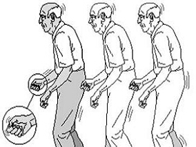 帕金森病：安慰剂也越贵越好？