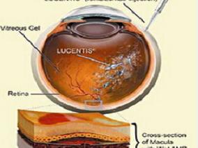 糖尿病黄斑水肿：兰尼单抗能降低起始治疗2年后VI和法定盲发病率