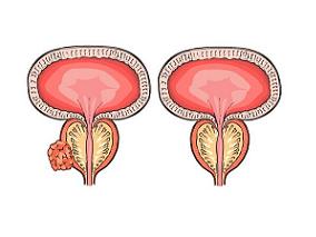 转移性前列腺癌中多西他赛的使用情况