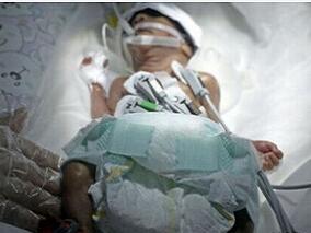 口服乳铁蛋白能降低早产婴儿败血症和坏死性小肠结肠炎风险