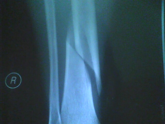 与抑酸药物联用对双膦酸盐预防骨折疗效有何影响？