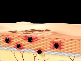 皮肤病：血浆英夫利昔、抗英夫利昔抗体水平与临床应答相关