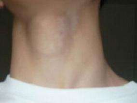 放射性碘治疗能改善中等风险甲状腺乳头状癌患者的生存期