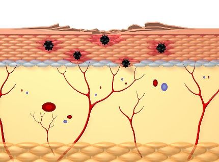 IVIG治疗激素难治性皮肌炎的成本效用如何？