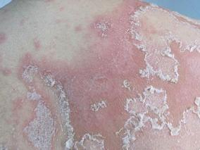 银屑病治疗的成本效果分析的系统回顾