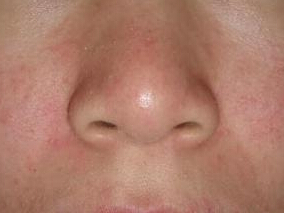 局部抗真菌药物治疗脂溢性皮炎的疗效