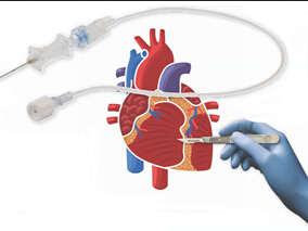 冠心病患者药物洗脱支架植入后：长期vs短期双抗治疗