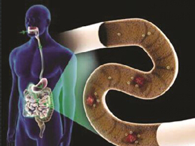 粪便移植能诱导活动性溃疡性结肠炎缓解